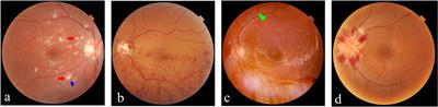 Ocular fundus changes and association with systemic conditions in systemic lupus erythematosus